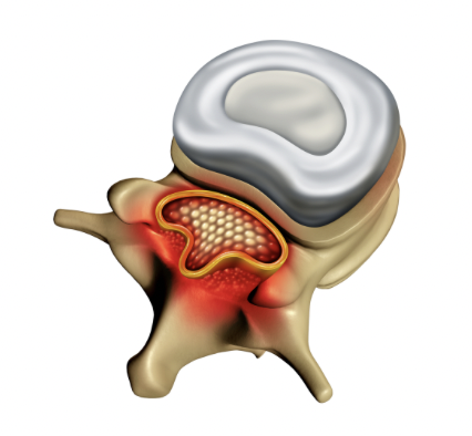 back pain spinal stenosis