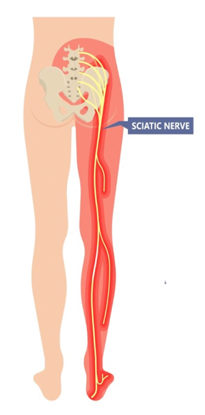 sciatica nerve back pain