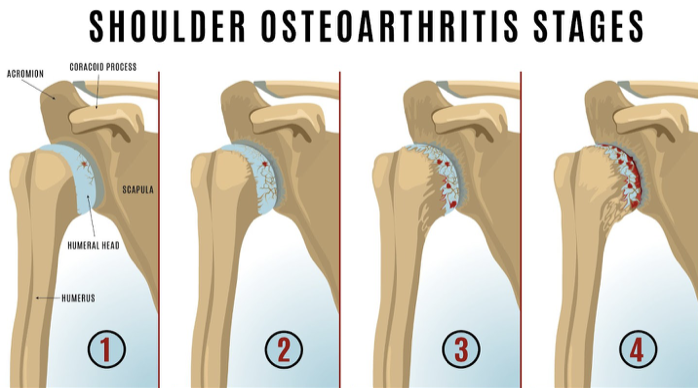 shoulder pain osteoarthritis stages
